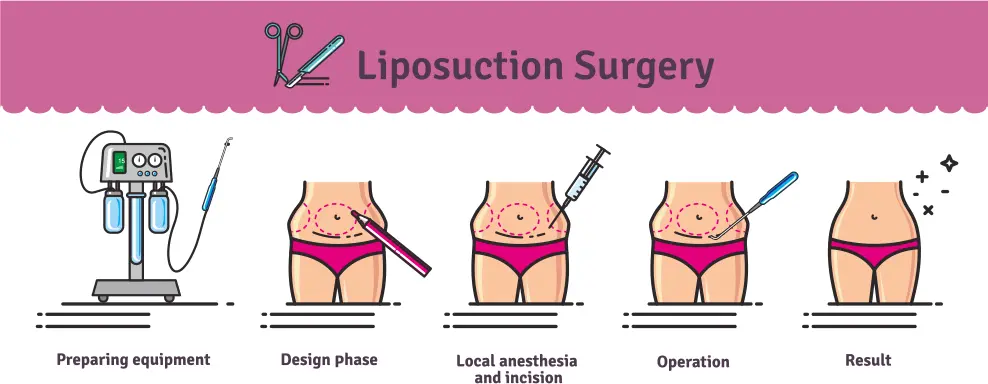 Liposuction and Non-Surgical Fat Removal in Poughkeepsie New York