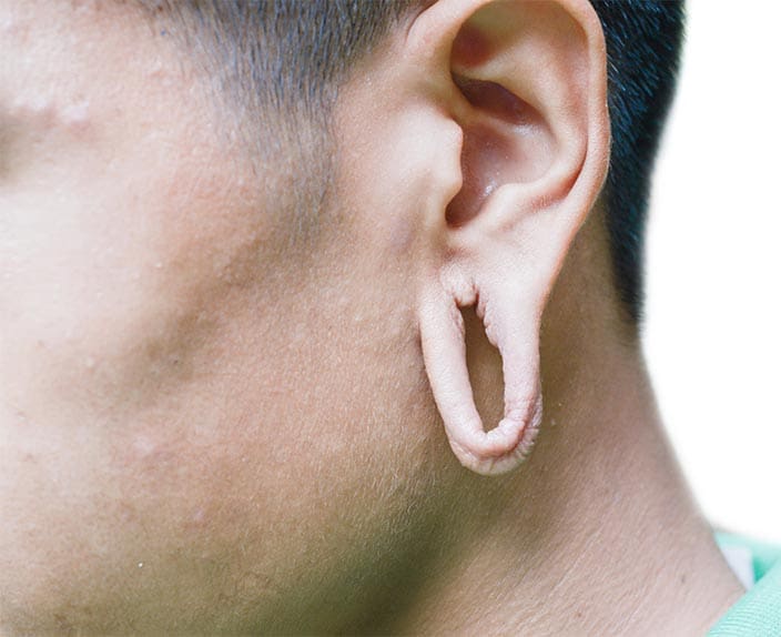 Ear Lobe Repair in Westchester NY