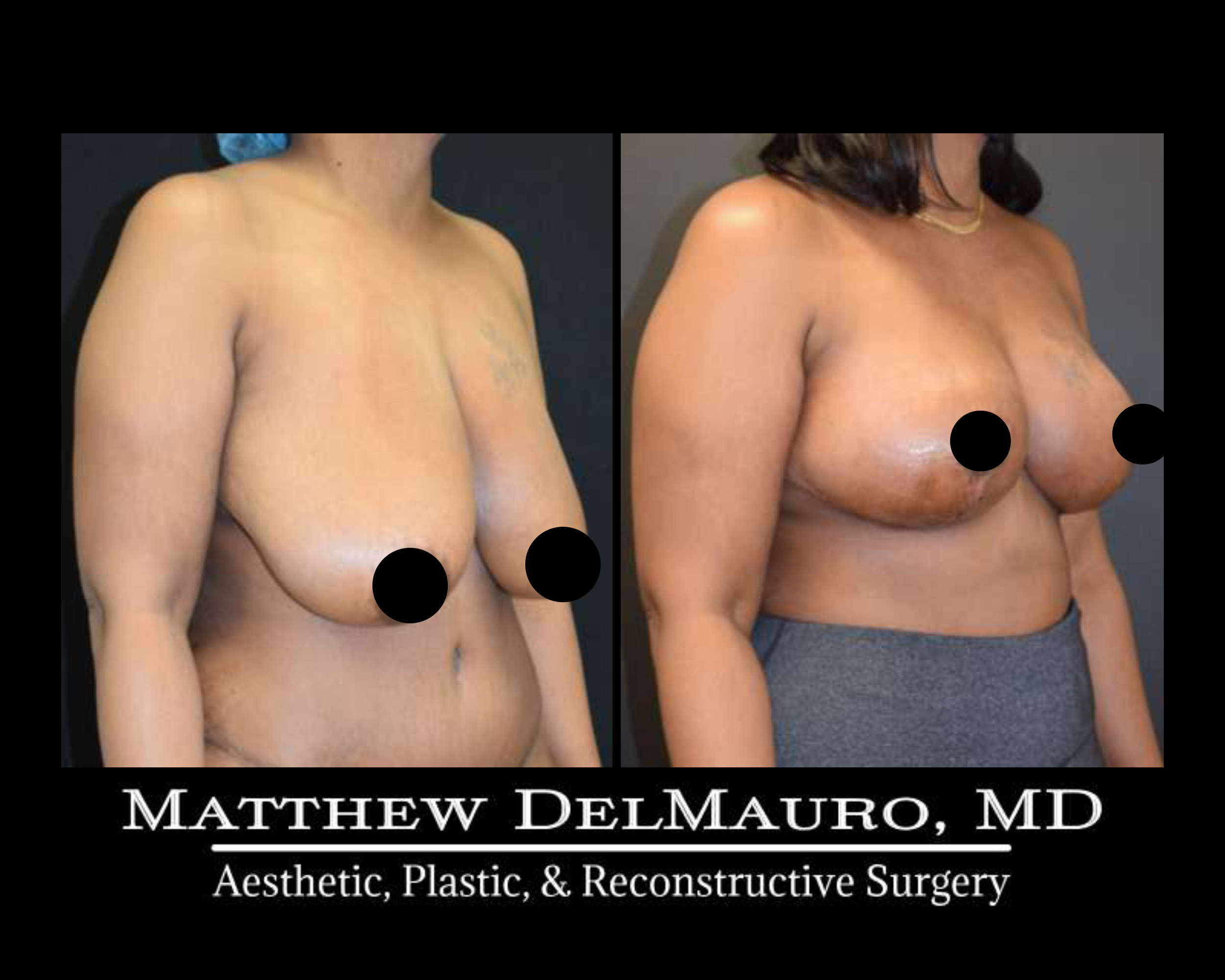 Breast Reduction Patient 1